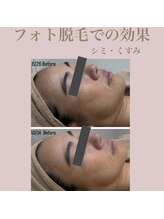 エステティック レイビス 新宿店(RAYVIS)/脱毛×フォトで効果抜群！！