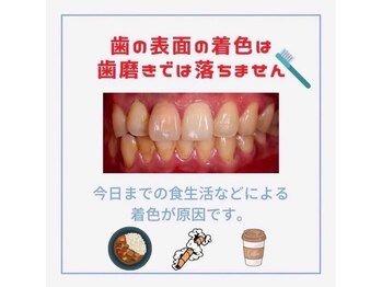ホワイトニングショップ 日進店/歯磨きでは落とせない？　日進市