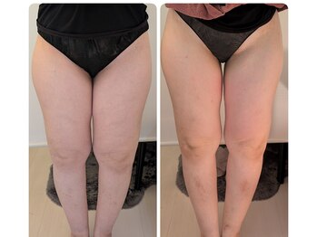 ワイズ(Y's)/脚前面、前もも