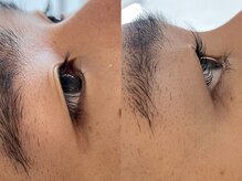 レレガンス(LELEGANCE)/メンズ逆まつげ改善