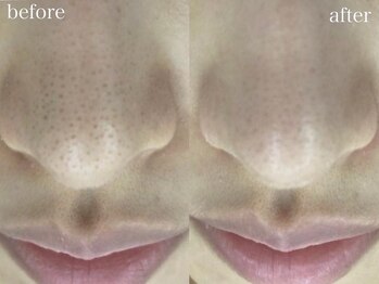 ホワイトアクア 池袋店(WHITE AQUA)/ハーブピーリング/毛穴洗浄/池袋