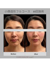 リュクシー(LuxeY)/小顔造形フルコース　10回施術