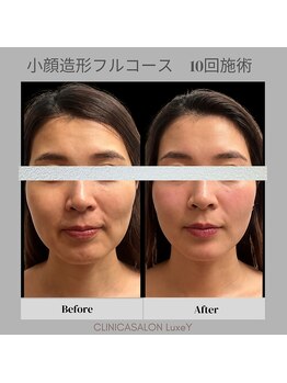 リュクシー(LuxeY)/小顔造形フルコース　10回施術