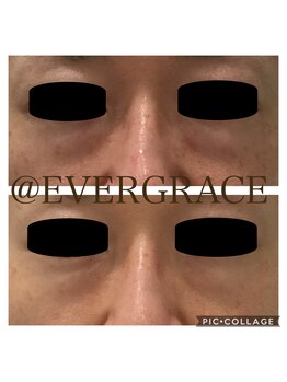 エヴァーグレース 川崎店/改善実績多数！目元ケアコース