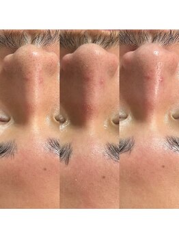 スピカ(Spica)/毛穴エクストラクション