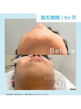 メンズクリア 藤沢OPA店/【メンズクリア】お客様の施術例