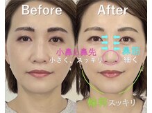 ラプリアンジュ 鹿児島天文館店(Raplit ange)/隆鼻矯正＋輪郭矯正40分　10回