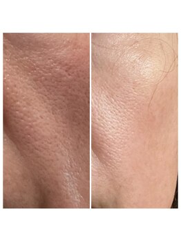 エヌ スタイル(N Style)/リベルハーブピーリング 