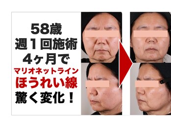 ボディアーキ 中野店(BODY ARCHI)/ほうれい線　マリオネットライン