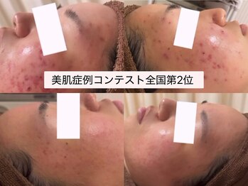 ミベル フェイシャルサロン(MIBELL FACIAL SALON)/美肌症例コンテスト全国2位