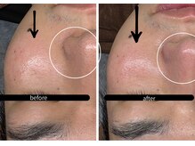 ビノスビューティー(vinos.beauty)/ReLaBeauteハーブピーリング