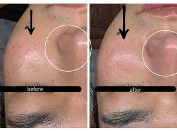 ビノスビューティー(vinos.beauty)/ReLaBeauteハーブピーリング