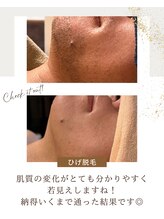 ヒーリングリゾート ナゴミ(Nagomi)/ひげ脱毛