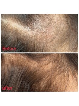 ニューユー(NewYou)/ノアグロウスカルプ