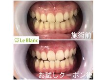 ルブラン 奈良店(Le Blanc)/歯石取りもとても大事です！