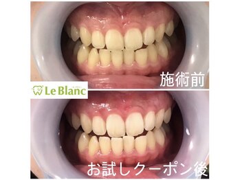 ルブラン 奈良店(Le Blanc)/歯石取りもとても大事です！
