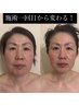 【お写真掲載可能な方】RF小顔整顔リフト×輪郭矯正