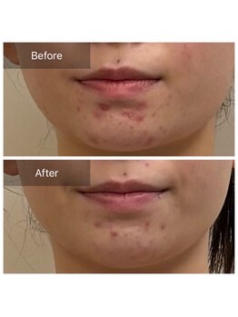 リバース(Rebirth)/次世代ハーブピーリング