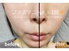 プラズマフェイシャル（単体）￥8000　ヘッドスパ、マスクパック付き♪