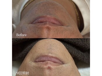 シュカ(Shuka)の写真/大人気の髭脱毛！