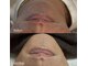 シュカ(Shuka)の写真/大人気の髭脱毛！