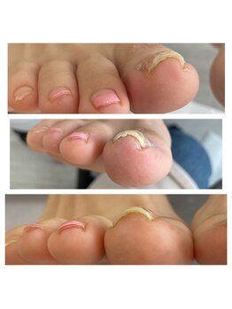 ミミ(mimi)/巻き爪ケア