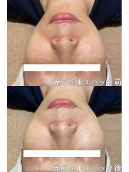 クレアナ ザ ビューティー(KULEANA the beauty)/光フォト+モデリングパック