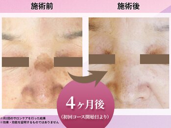 クリニカルエステ花蔵 スズラン高崎店/【コース開始4か月経過時点】