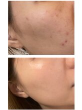 モンクラッシー(Mon classy)/2B befor/after