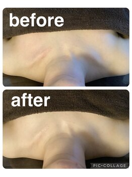 ギンザアール(GINZA R.)/肩こりに◎