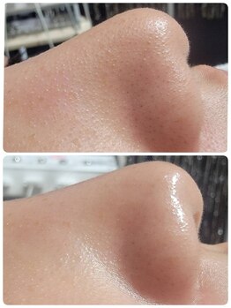 ナナナ モエ(Na3 Moe)/小鼻の黒ずみ　角栓詰まり