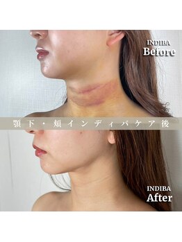 術後の女神 大阪心斎橋店/術後ケアインディバ・インディバ