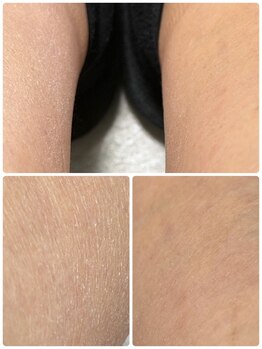 アンヴィオ ギンザ(Anvio Ginza)/ワックスでピーリングケア