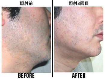 ストック 立花店(STOCK)/【ヒゲ】もみあげ照射前→3回