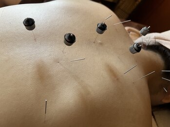 サラン鍼灸院(SARAN都楽鍼灸院)/身体の鍼灸(灸頭鍼)