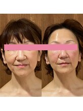 サロンドミジュ(Salon de 美jyu)/最高品質ヒト幹細胞上清液導入