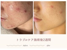 エステティックサロン シーズ/2週間後の肌変化