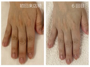 キレイテ 上野店/50代/6回目【ハンドケア上野】