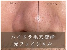  Lashenlanka四日市【ラシェンランカ】リラクゼーションマッサージ/フェイシャル/脱毛の雰囲気（ごっそり毛穴の汚れを！）