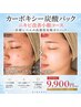 【毛穴悩み/ニキビ特化ケア】高濃度カーボキシー炭酸パック★ニキビ根本ケア
