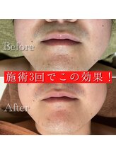 ジェニー バイ JVC(genie by JVC)/ジェニーの脱毛最新機器の効果！