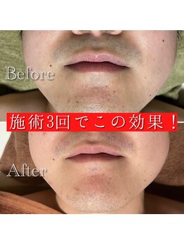 ジェニー バイ JVC(genie by JVC)/ジェニーの脱毛最新機器の効果！