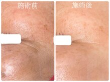 フォーチューン/フェイシャルワックス×ハーブ