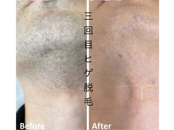 CDF 赤坂/メンズヒゲ脱毛３回目初回￥1000