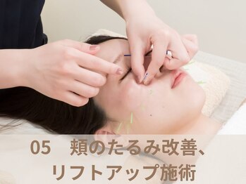 オムリス鍼灸接骨院/美容鍼の流れ オムリス/駒込店