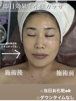 ポレ(pole)/お顔引きあげ◎即日小顔！