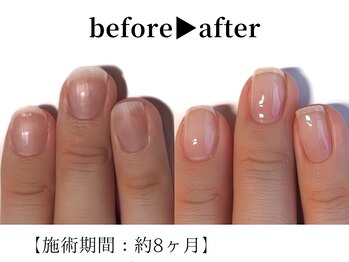 リング ザ ベル(ring the bell)/深爪・育爪専門コース