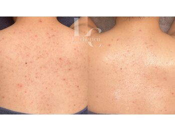 ルシェリア(Le cherien)/お背中ハーブピーリング