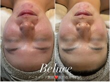 ベルーチェ(Beluce)の雰囲気（頑固なニキビも綺麗な艶美肌に　ハーブピーリング/毛穴洗浄）