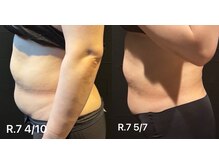 ビトタン 倉敷本店(+美to鍛)/レモンボトルお腹